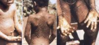 Monkey Pox Symptoms